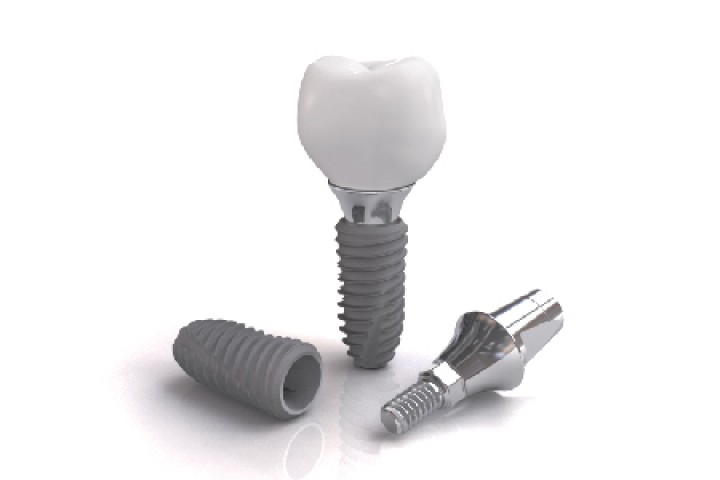 LỢI ÍCH KHI CẤY GHÉP IMPLANT NHA KHOA CÙNG DENTIUM